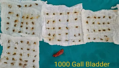 more than 1000 stones successfully removed from 30 year old female’s gallbladder
