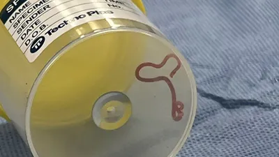 doctors remove 3 inch long live parasitic worm from australian woman’s brain