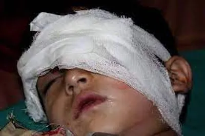 crpf aids treatment of child with rare eye disease in udhampur